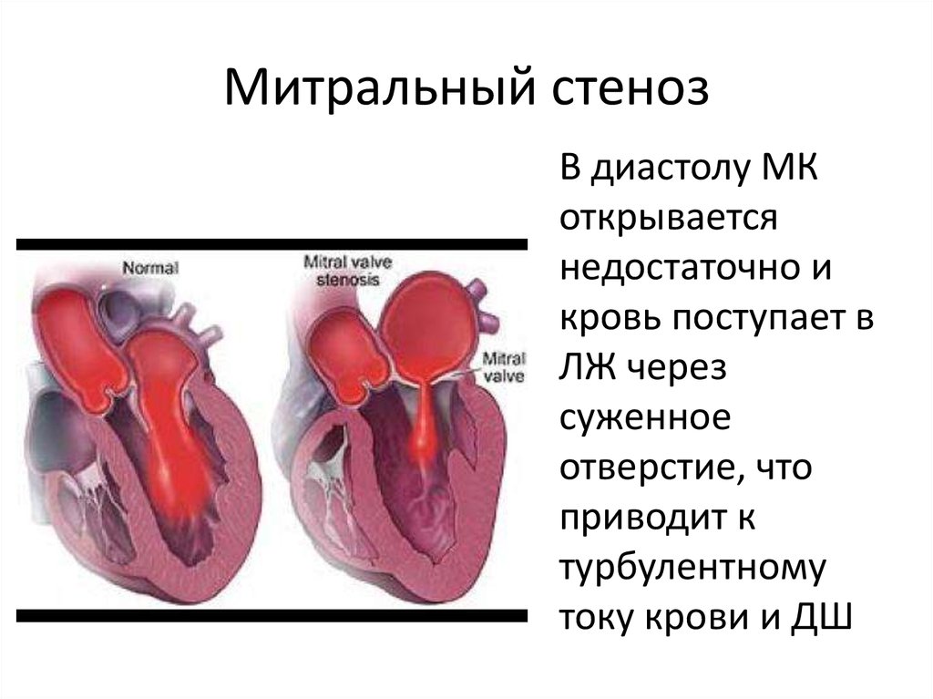 Сердечная недостаточность митрального клапана. Стеноз митрального клапана сердца. Ревматизм и стеноз митрального клапана. Митральный стеноз отверстие клапана. Стенах митрального отверстия.