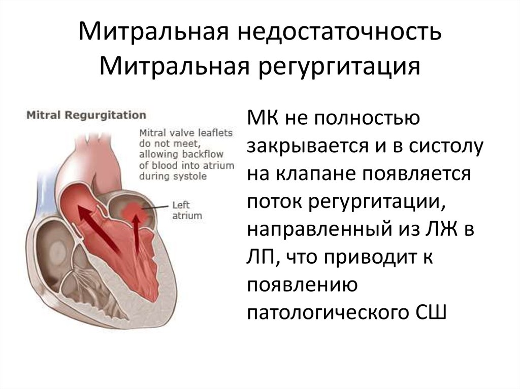 Что такое митральная регургитация