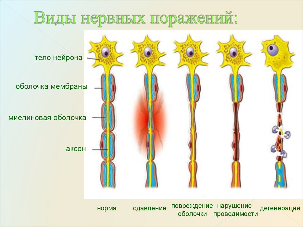 Тип поражения аксональный. Дегенерация нервных волокон гистология. Повреждение нервных волокон. Регенерация периферического нерва. Регенерация миелиновых нервных волокон.