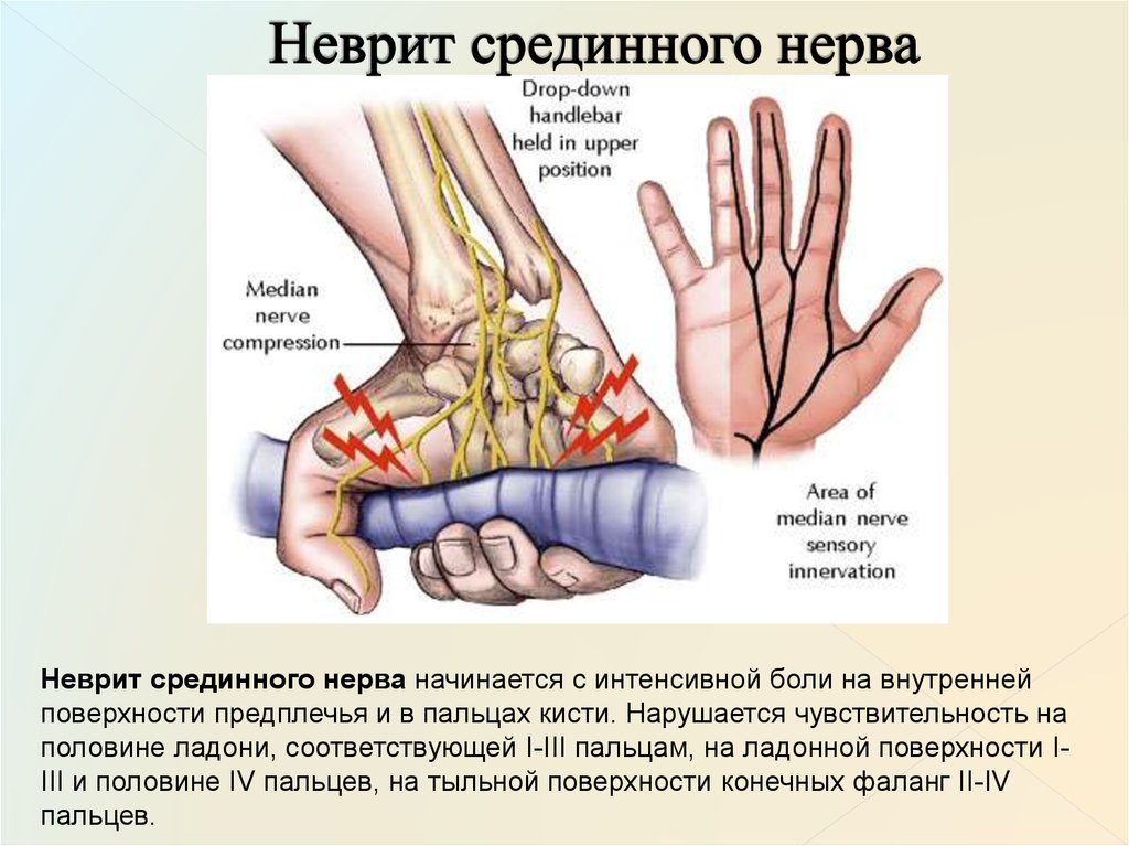 Нейропатия правого нерва. Повреждение срединного нерва. При поражении срединного нерва. Повреждение срединного нерва симптомы.