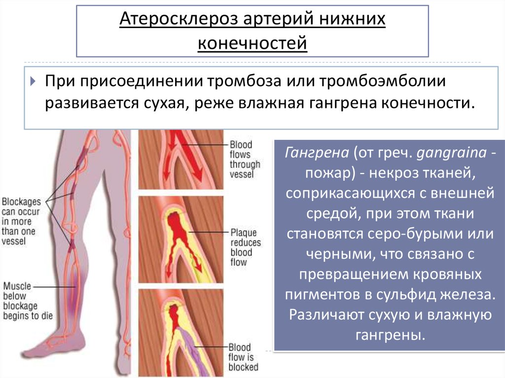 Тромбоз артерия и вена. Облитерирующий атеросклероз бедренной артерии. Острого тромбофлебита глубоких вен конечности клиника. Атеросклероз бедренной артерии. Клиника острого тромбоза артерий нижних конечностей.