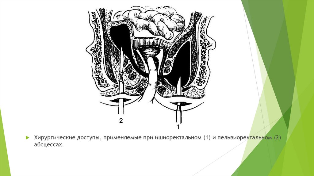 Острый парапроктит презентация