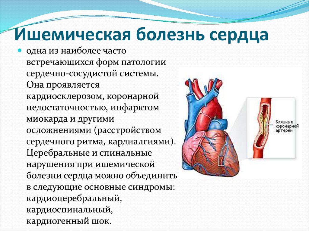 Почему ишемия. Ишемическая болезнь сердца. Заболевания сердца болезни. Патология сердечно сосудистой системы.