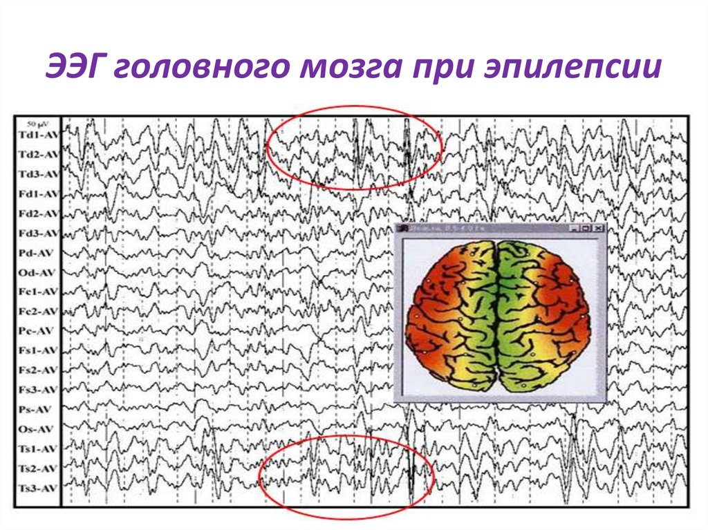 Ээг при эпилепсии. Генерализованная эпилепсия ЭЭГ. ЭЭГ больного эпилепсией. Электроэнцефалография головного мозга (ЭЭГ). ЭЭГ здорового человека и эпилептика.