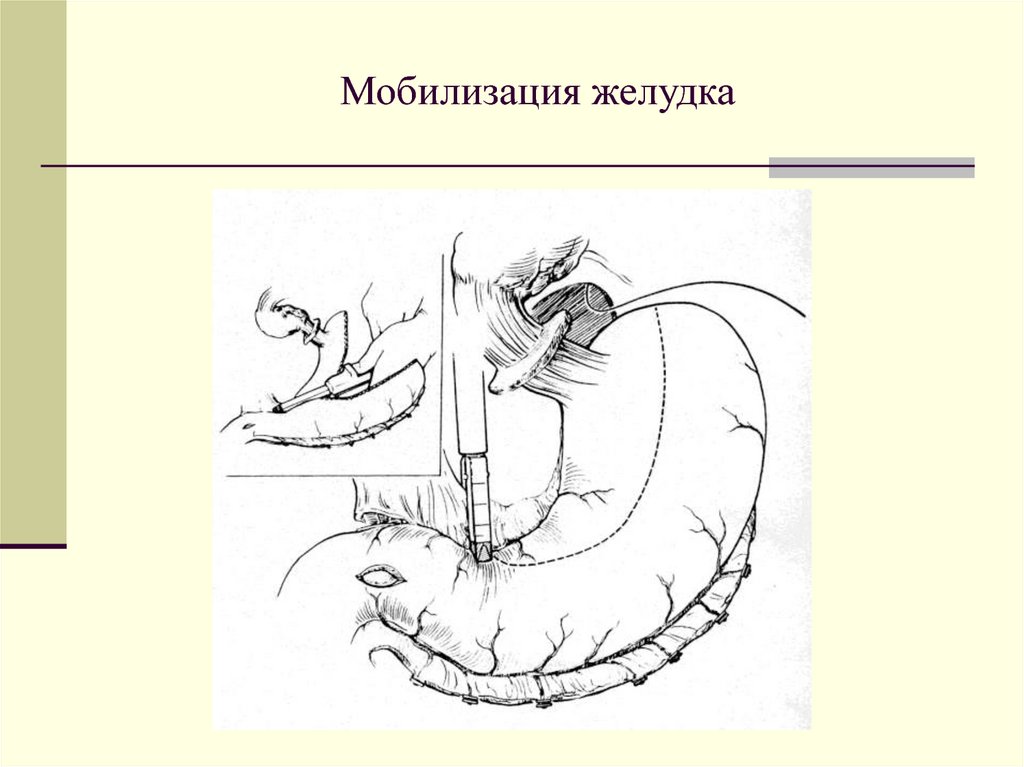 Схема операции. Резекция желудка мобилизация. Связки которые рассекают при мобилизации желудка.