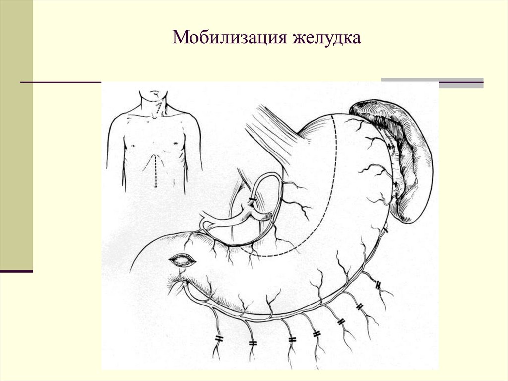 Схема мобилизации двенадцатиперстной кишки по кохеру