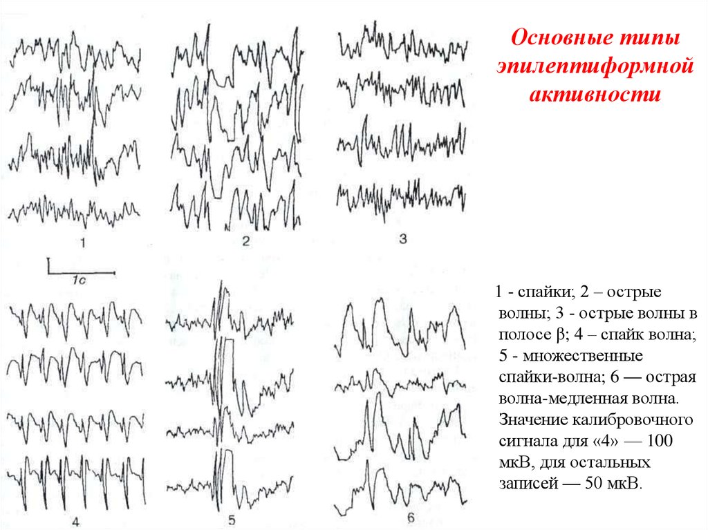 Пароксизмальная активность головного. Эпилептиформные паттерны на ЭЭГ. Спайк волновая активность на ЭЭГ. ЭЭГ эпилепсия пик-волна. Комплекс острая медленная волна на ЭЭГ.