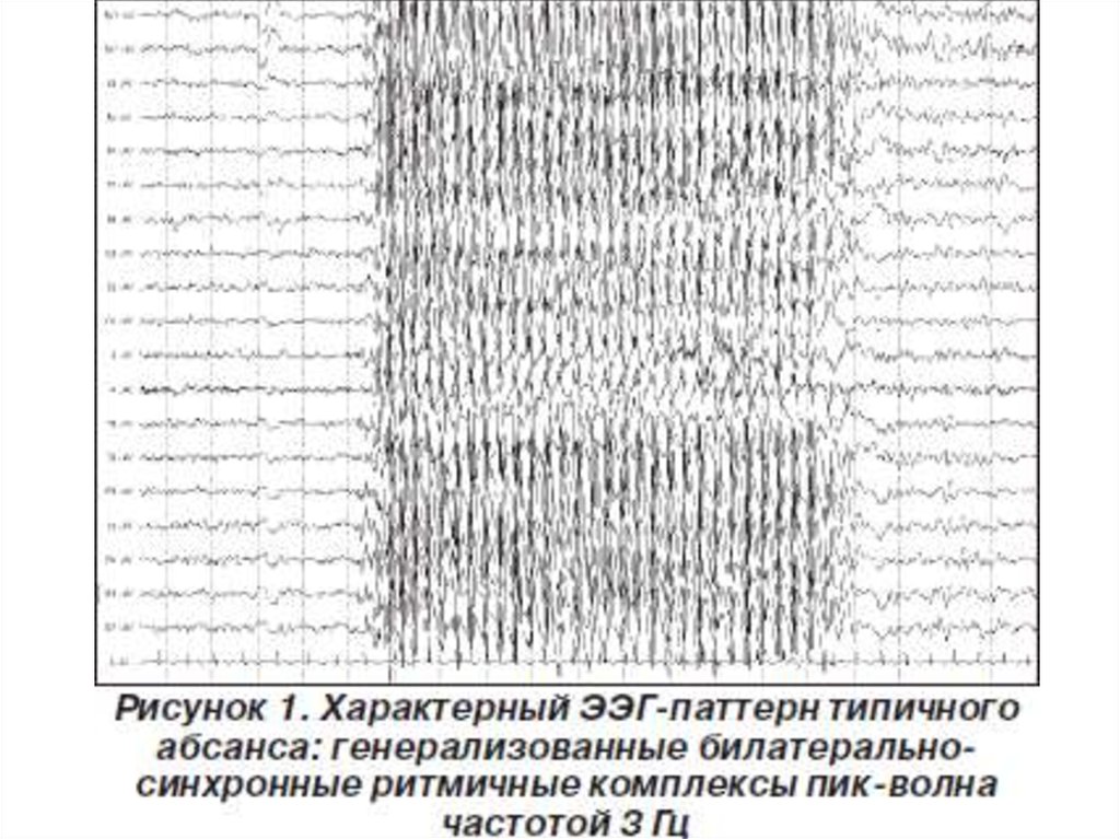 Ээг показывает эпилепсию. ЭЭГ эпилепсия пик-волна. Миоклоническая эпилепсия ЭЭГ. Абсансная эпилепсия на ЭЭГ. Генерализованные комплексы пик волна на ЭЭГ.