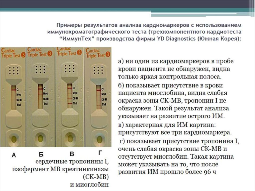Примеры результатов анализа кардиомаркеров с использованием иммунохроматографического теста (трехкомпонентного кардиотеста