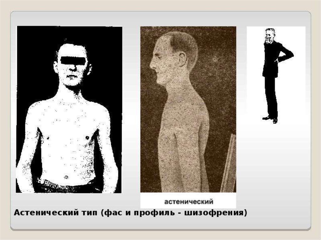 Астеническое телосложение. Форум астенический. Типы телосложения астенический нормостенический и гиперстенический. Гиперстенический тип грудной клетки. Типы телосложения человека астеник.