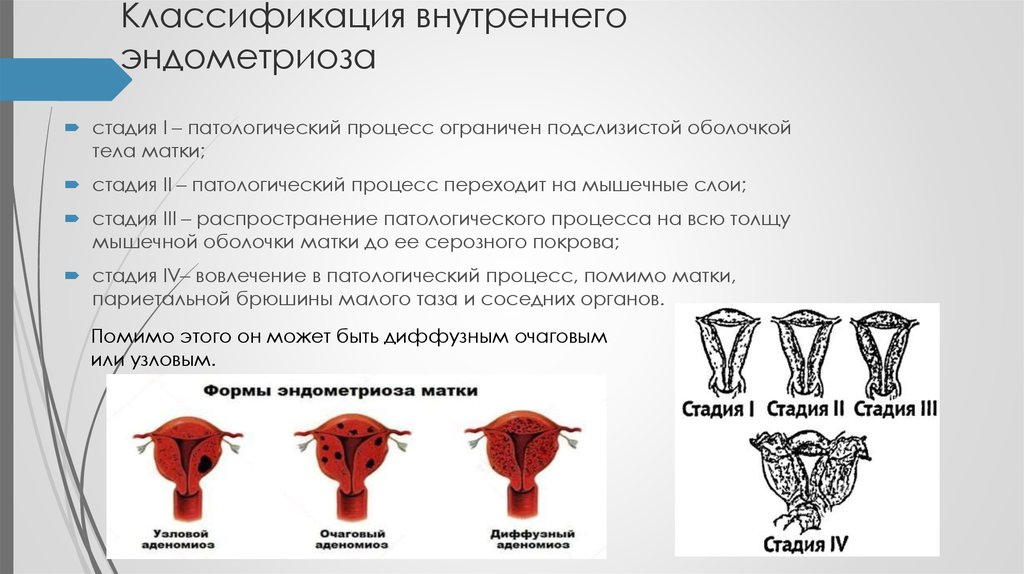 Эндометрия узлов. Эндометриоз тела матки 2-3 степени. Классификация внутреннего эндометриоза. Эндометриоз тела матки 1 2. Наружный генитальный эндометриоз классификация.