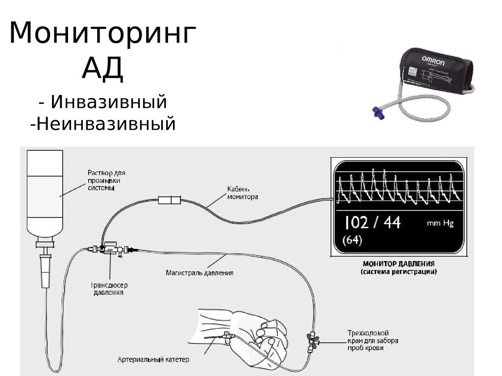 Прямое давление. Инвазивное артериальное давление методика измерения. Система для измерения инвазивного ад. Система для инвазивного мониторинга артериального давления. Инвазивный способ измерения артериального давления.