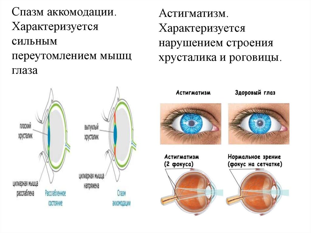 Миопия астигматизм глаз. Хрусталики глаза строение глаза. Аккомодация симптомы. Спазм аккомодации глаз. Спазм аккомодации ложная близорукость.
