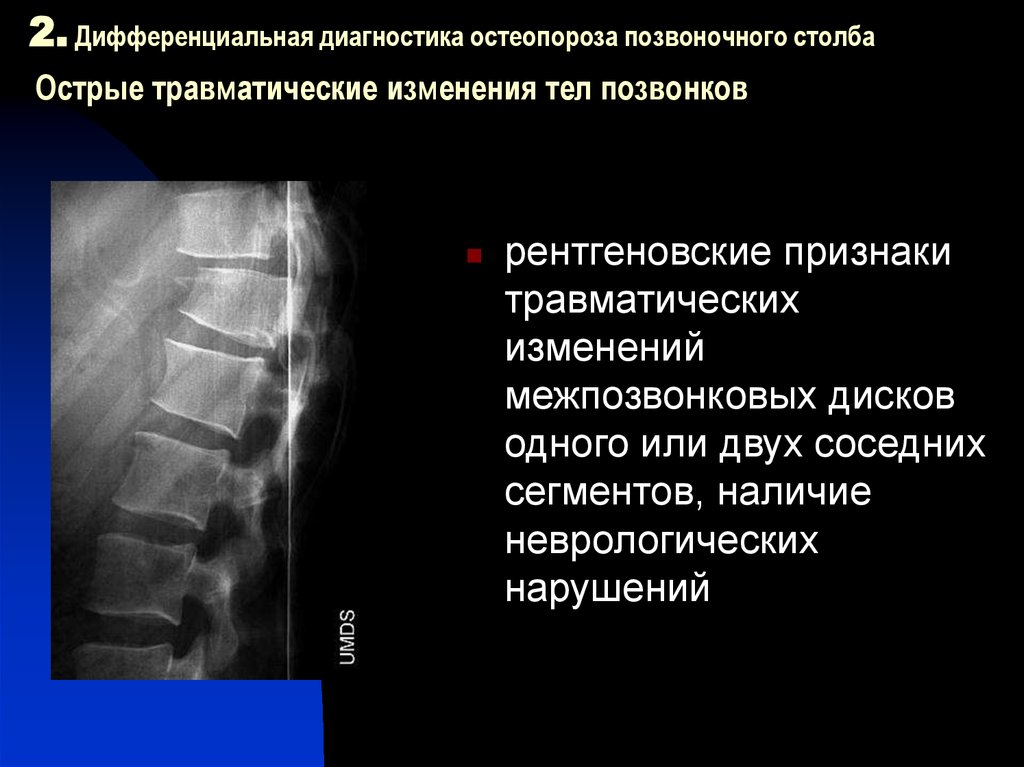 Остеопороз перелом позвоночника. Остеопороз компрессионный перелом позвоночника. Остеопороз тела позвонка кт.