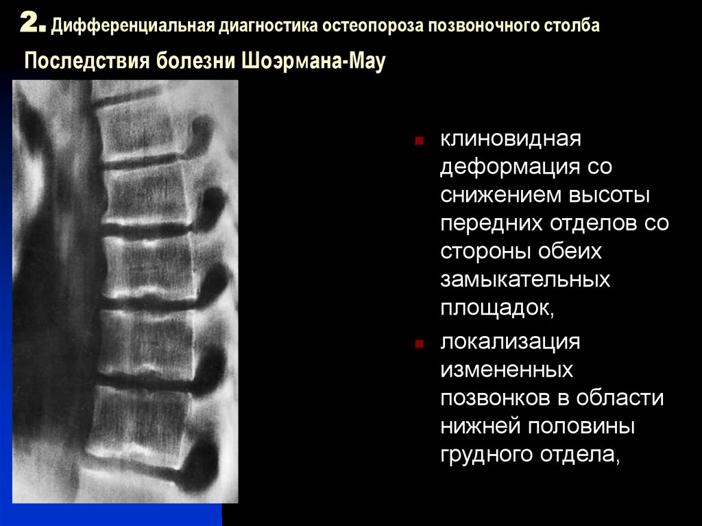 Деформация позвонков. Клиновидная деформация l1 1ст. Клиновидная деформация l2 позвонка. Клиновидная деформация тела th8 позвонка. Передняя клиновидная деформация тела th7.