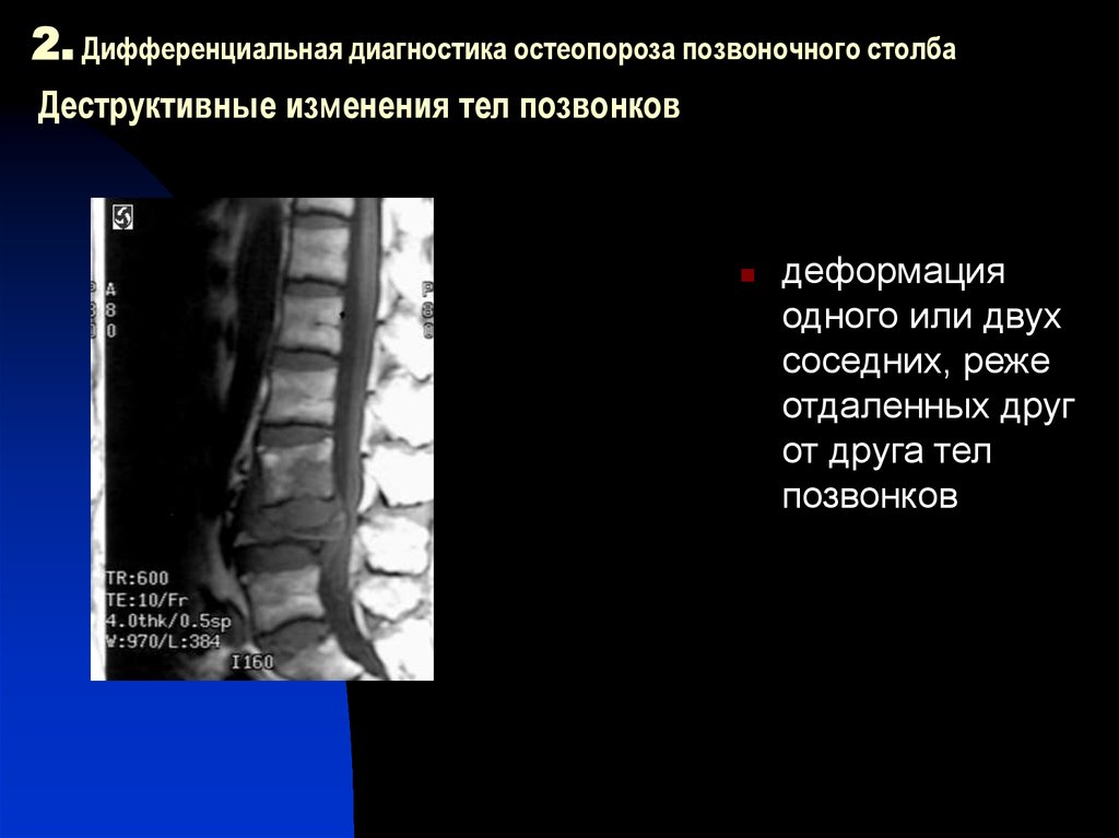 Изменения позвоночника. Изменения тела позвонка. Деструктивные изменения позвонков. Диф диагноз остеопороза. Деструктивные изменения в позвоночнике что это.