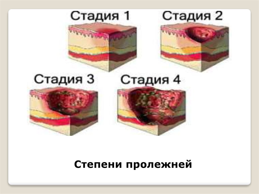 Пролежни причины