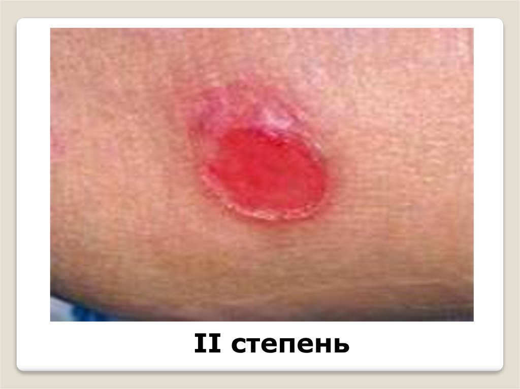 Пролежни. Степени поражения. Уход. Профилактика. Сестринское дело ...