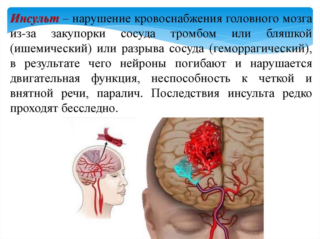 Правосторонний инсульт прогноз. Инсульт сосудов головного мозга. Артерии мозга при инсульте.