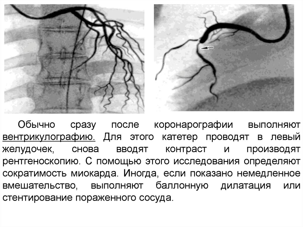 Коронография что. Коронарография сосудов сердца. Коронарография норма и патология. Коронарография методика проведения.