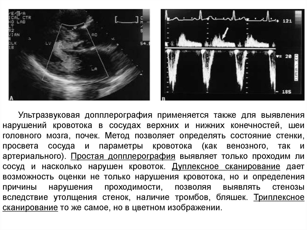 Узи верхних. Допплерография сосудов почек протокол. Ультразвуковая допплерометрия. Допплерометрия сосудов нижних конечностей. Ультразвуковая допплерография сосудов верх конечностей.
