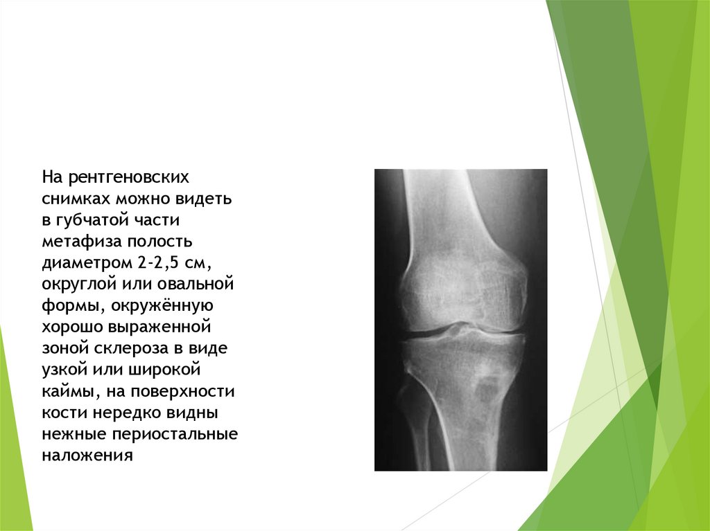 Склерозирующий остеомиелит