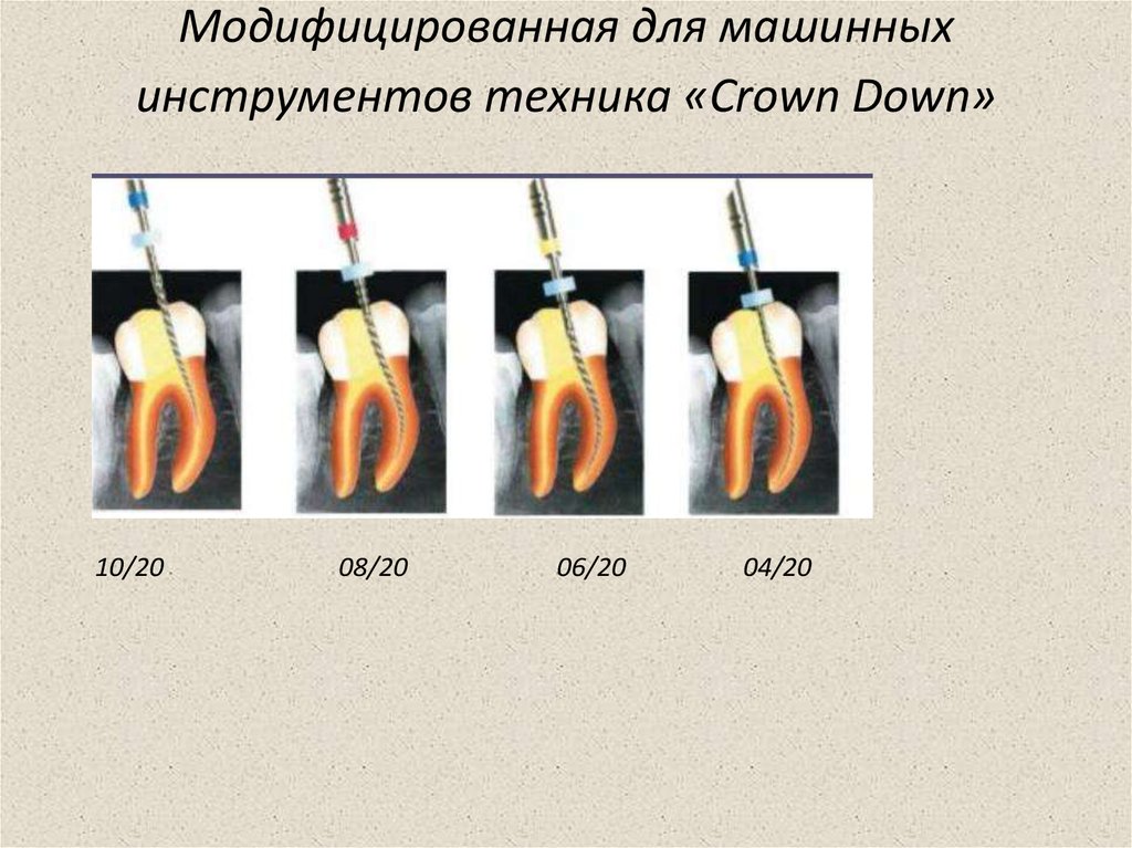 Конусность корневого канала