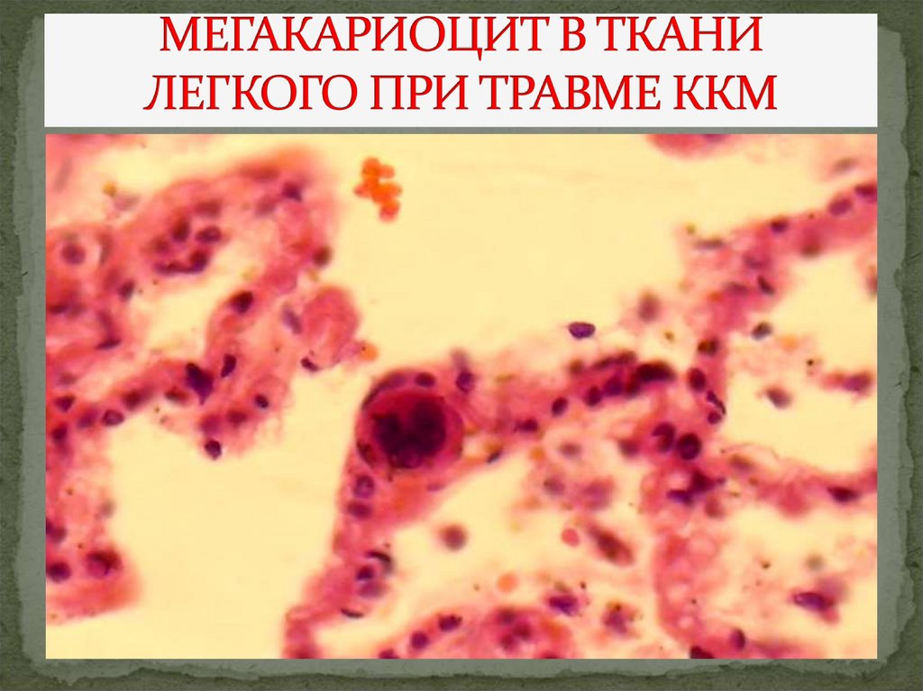 МЕГАКАРИОЦИТ В ТКАНИ ЛЕГКОГО ПРИ ТРАВМЕ ККМ