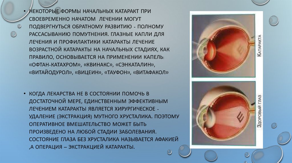 Что можно делать после катаракты. Этапы экстракции катаракты. Пациента к экстракции катаракты.