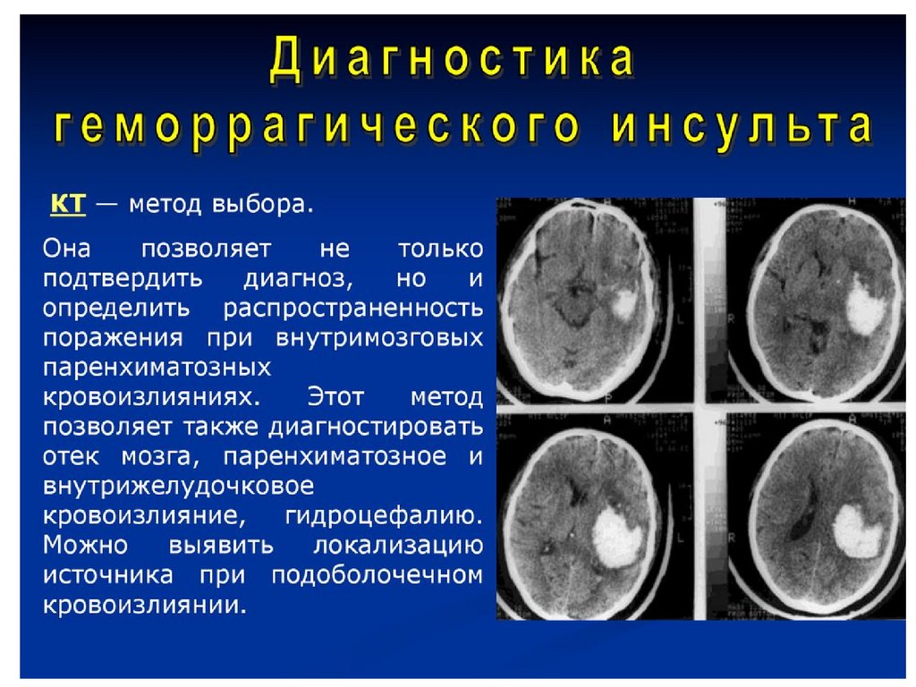 Был геморрагический инсульт. Геморрагический инсульт головного мозга кт. Геморрагический инсульт мозга на кт. Методы исследования при геморрагическом инсульте. Геморрагический инсульт диагноз.