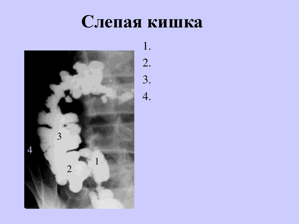 Симптомы боли слепой кишки. Слепая кишка презентация.