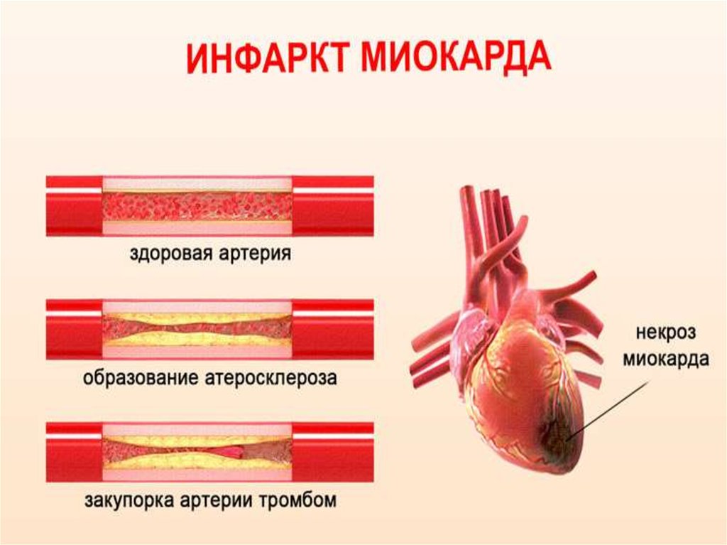 Главный признак типичного течения инфаркта миокарда