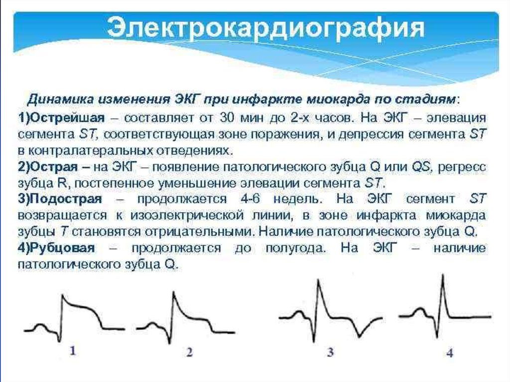 Оим это. Стадии инфаркта миокарда ЭКГ изменения. ЭКГ при острейшей фазе инфаркта миокарда. Острейший период инфаркта миокарда на ЭКГ. Основной признак инфаркта миокарда на ЭКГ.