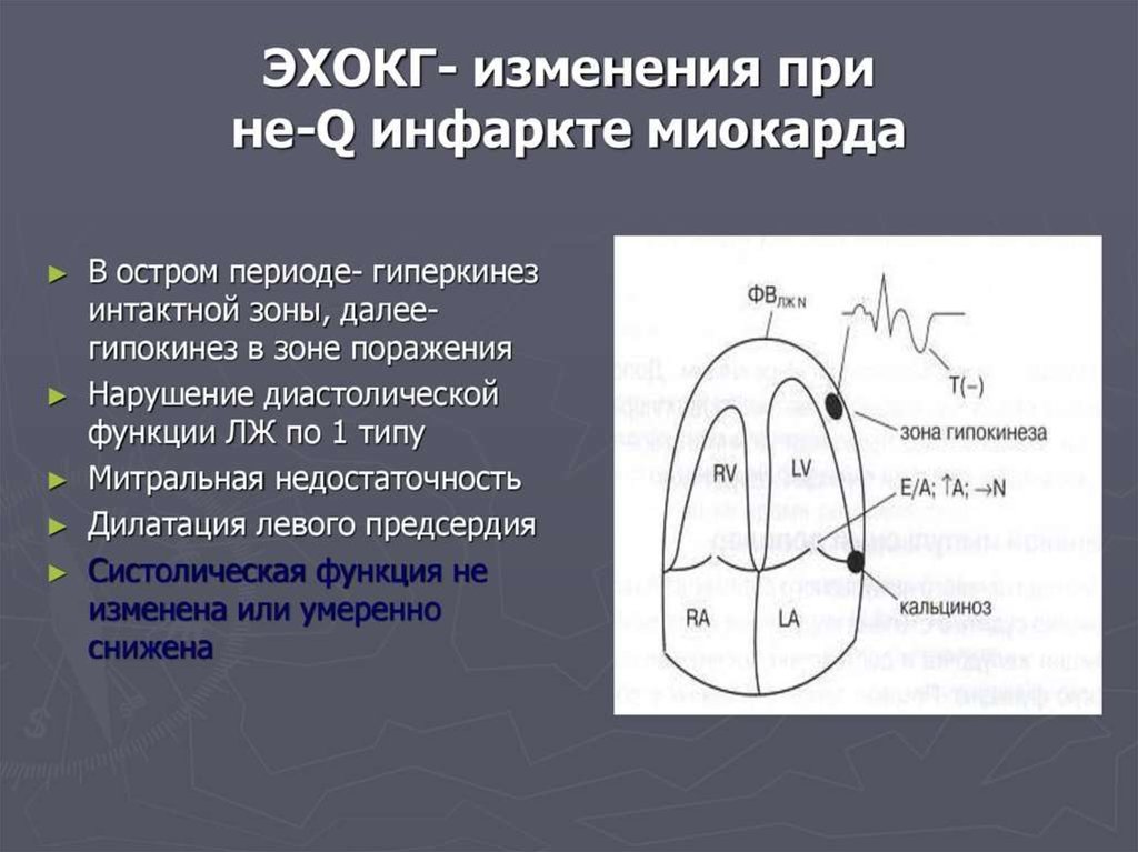 Эхо ЭКГ при инфаркте миокарда. ЭХОКГ при инфаркте миокарда. Инфаркт миокарда УЗИ Эхо-кг. Эхо критерии инфаркта миокарда.