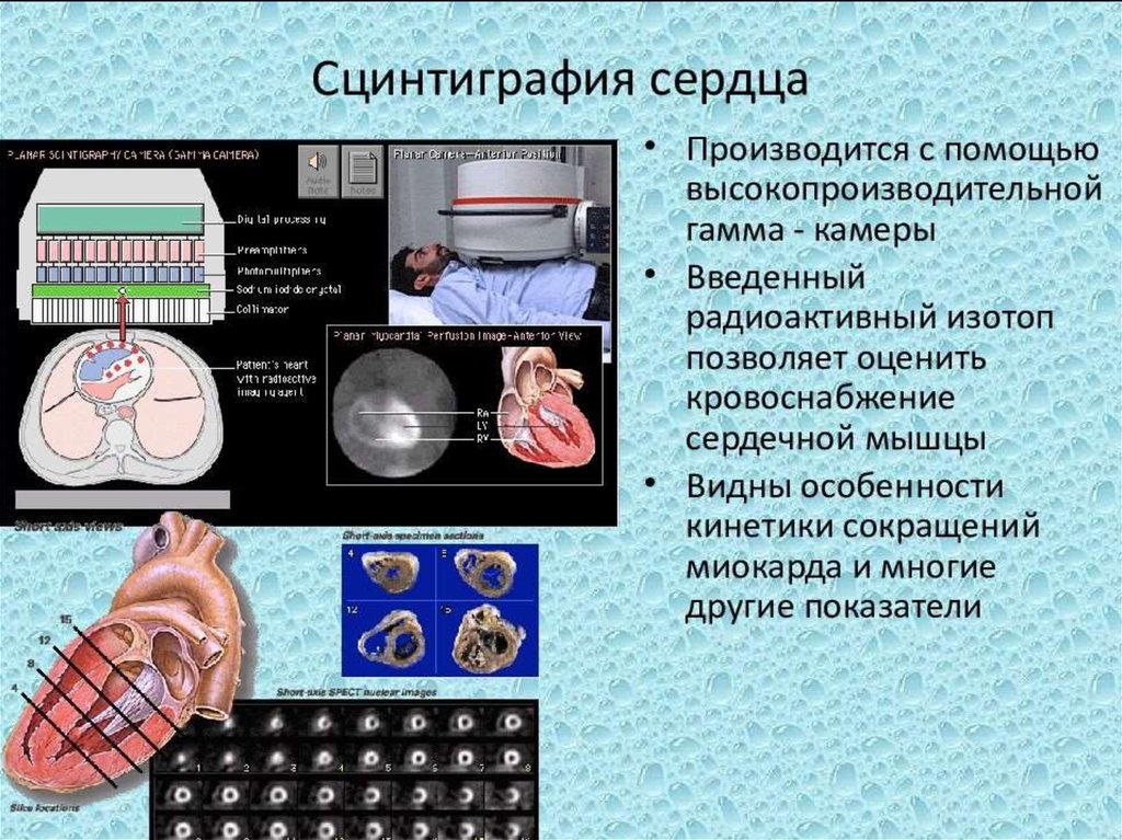 Презентация сцинтиграфия миокарда