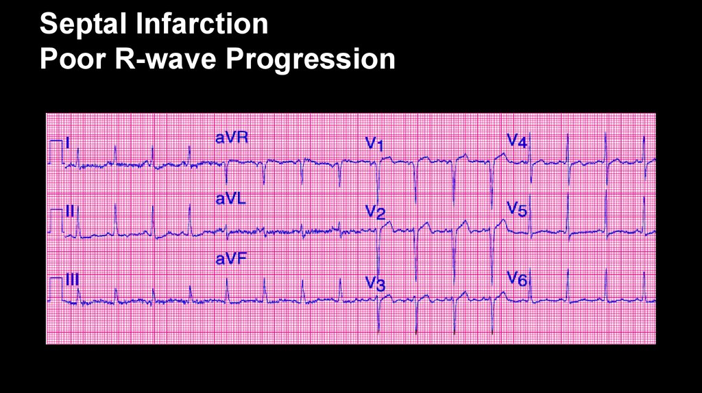 What Is A Septal Infarct