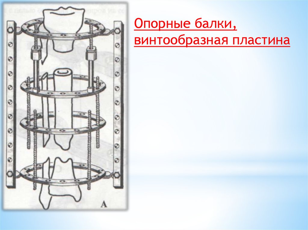 Аппарат илизарова презентация