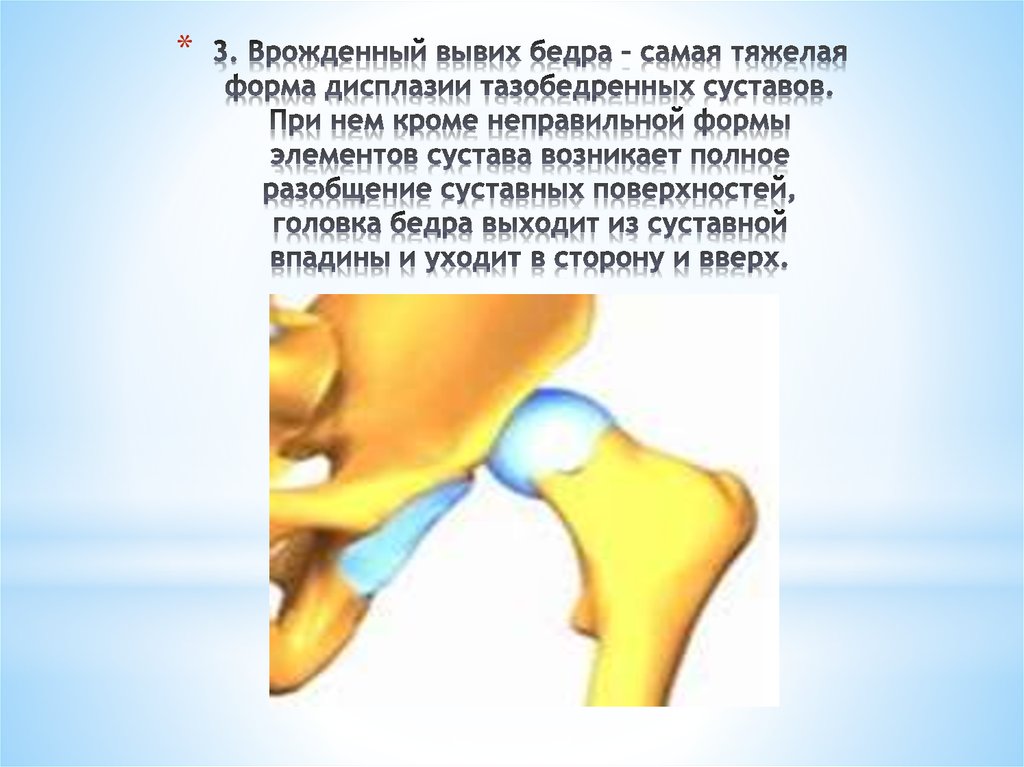 Врожденный вывих бедра. Врожденный вывих бедра патогенез. Врожденный вывих бедра этиология. Мкб врожденный вывих бедра. Дисплазия тазобедренных суставов у детей мкб.