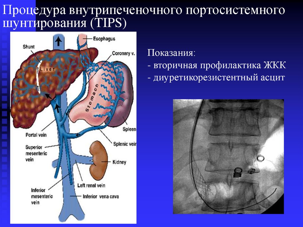 Желудочно кишечное кровотечение карта вызова