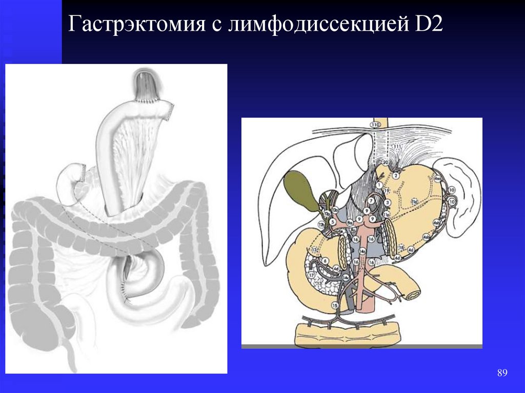 Гастрэктомия по сигалу схема