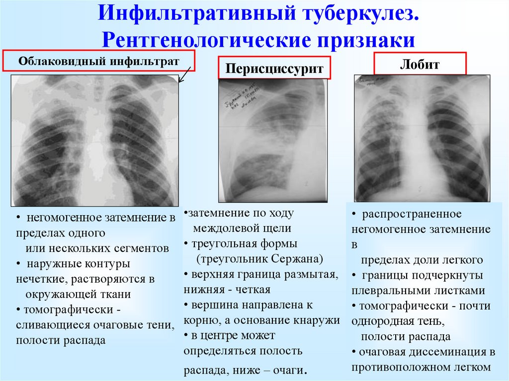 Причины изменений в легких. Инфильтративный туберкулёз лёгких рентген. Инфильтративный туберкулез легких рентген. Инфильтративный туберкулёз рентген симптомы. Очагово-инфильтративный туберкулез рентген.