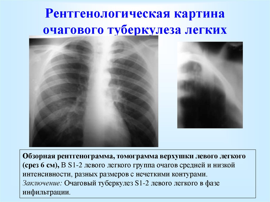 Изменения в верхней доле легкого. Инфильтративный туберкулез легких с1 с2 с 6. Очаговый туберкулез рентген. Очаговый туберкулез симптомы рентген. Инфильтративный туберкулез рентгенодиагностика.