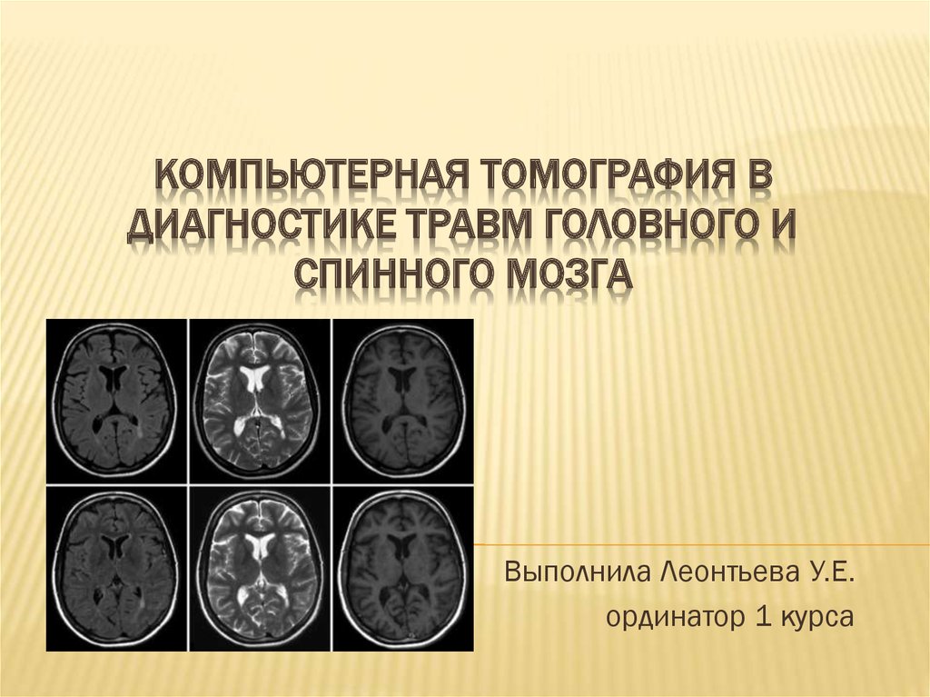 Компьютерная томография в диагностике травм головного и спинного мозга