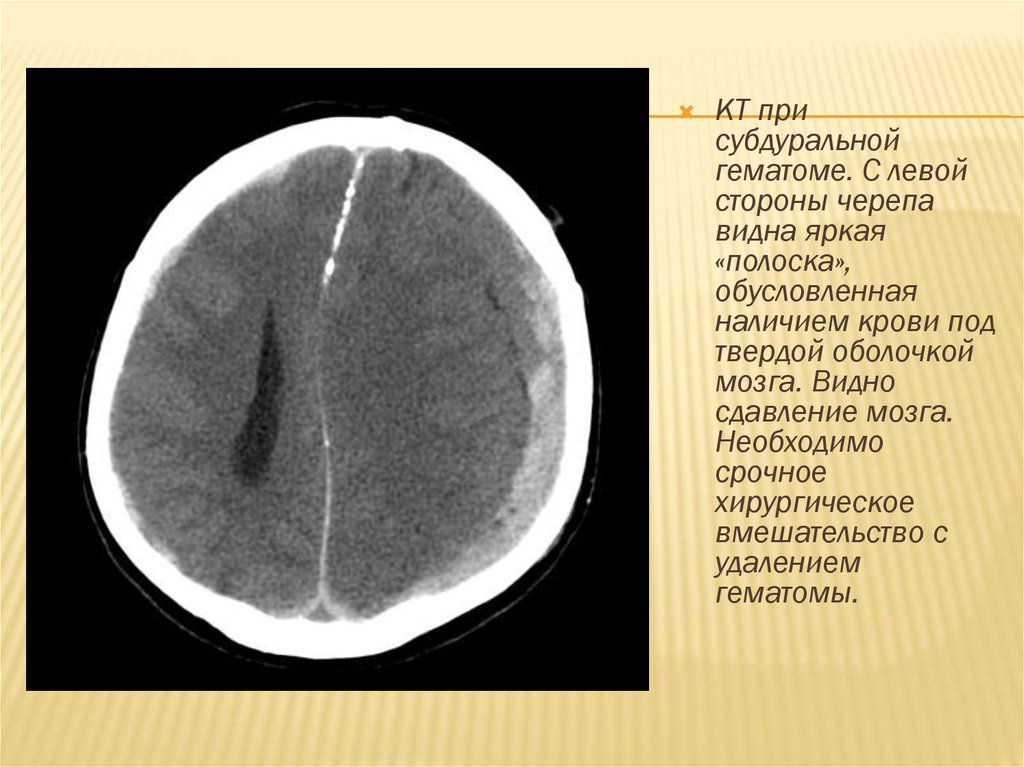 Субдуральная гематома. Хроническая субдуральная гематома на кт. Степени субдуральной гематомы кт. Субдуральная гематома головного мозга кт. Пластинчатая субдуральная гематома кт.