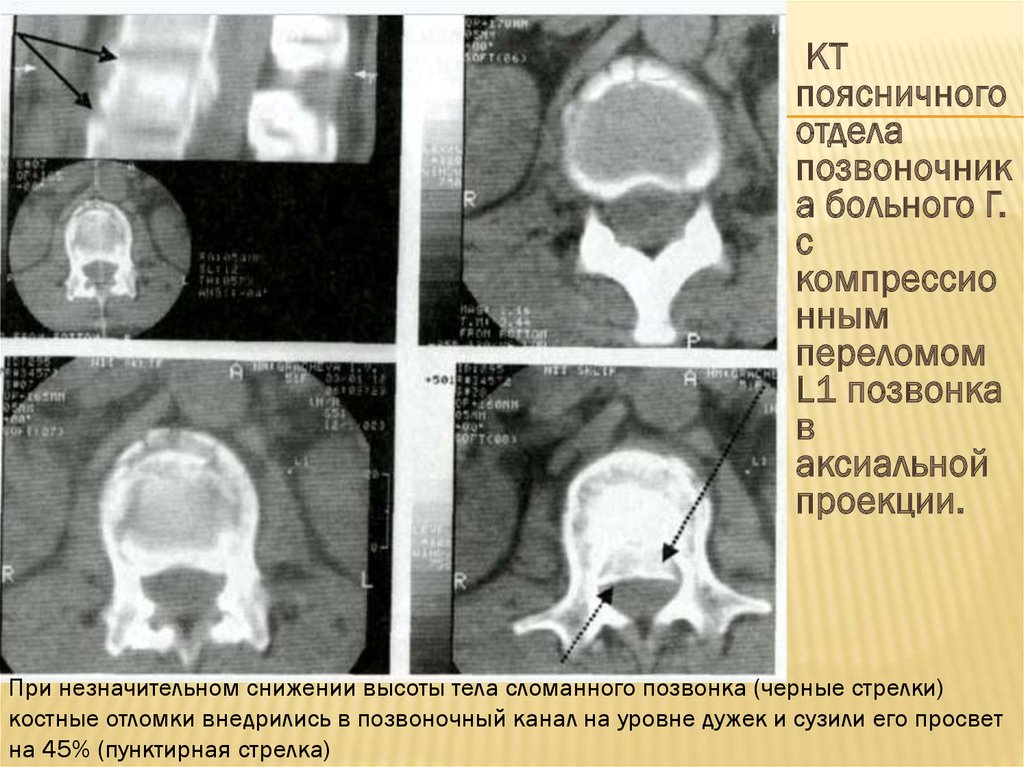 Кт поясничного отдела позвоночника. Аксиальная проекция кт. Кт позвоночника в аксиальной проекции. Перелом позвоночника в поясничном отделе на кт. Проекции позвонков на кт.