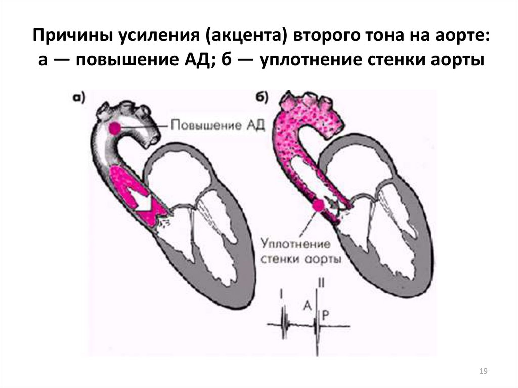 Уплотнение стенок аорты. Тоны сердца приглушены акцент 2 тона на аорте. Акцент второго тона над аортой схема. Акцент 2 тона на аорте синдром. Усиление II тона на аорте.