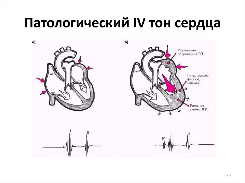 Схема тоны сердца