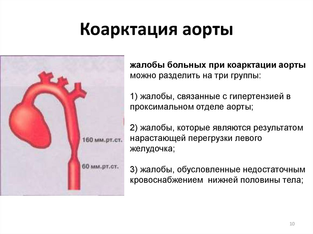 Коарктация аорты картинки