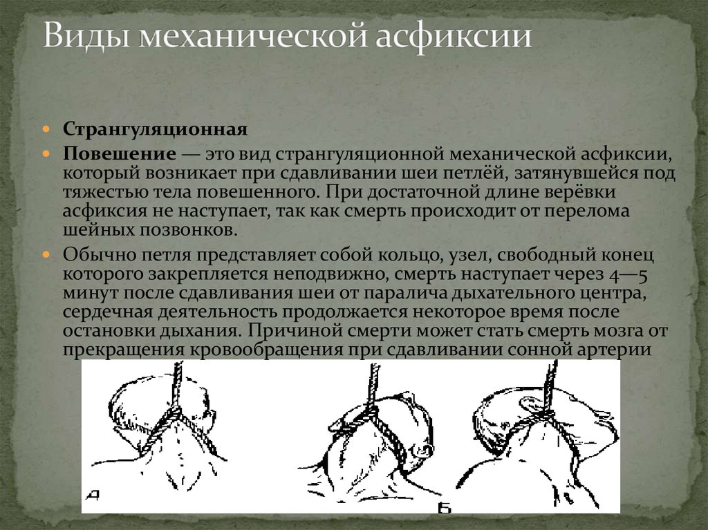 Придушивает во время. Механическая странгуляционной асфиксии. Причины механической асфиксии. Виды механической странгуляционной асфиксии.