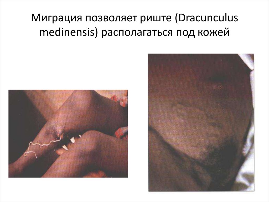 Миграция позволяет риште (Dracunculus medinensis) располагаться под кожей